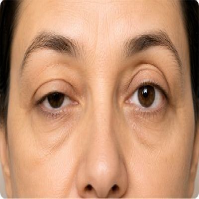 Droopy Eyelids & Ptosis